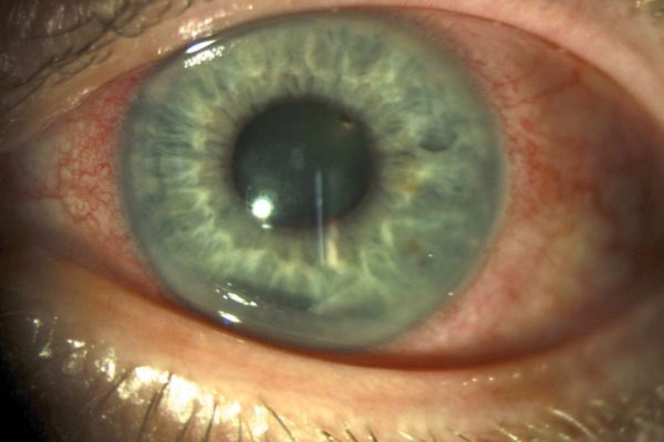 Dry Eye In Monocular Patients